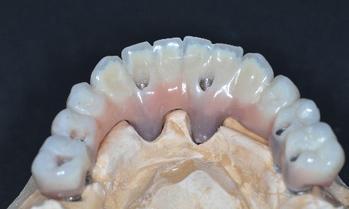 Dentistes Saint Marcellin prothèses dentaires